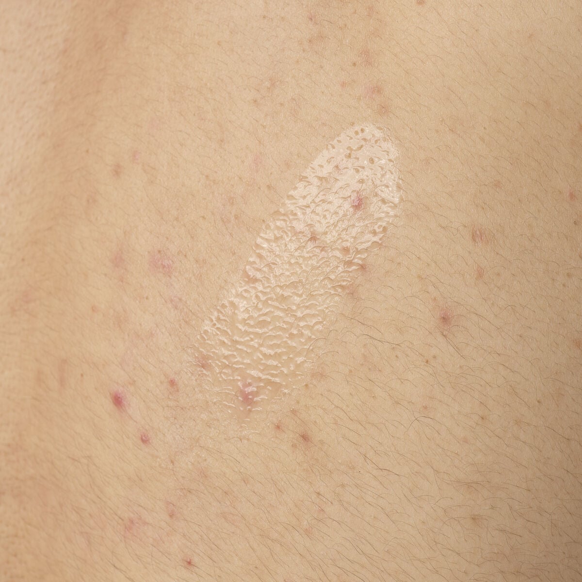 salicylic-acid-0-5-body-serum-p6 ORD-salicylic-acid-05-body-240ml-application.jpg