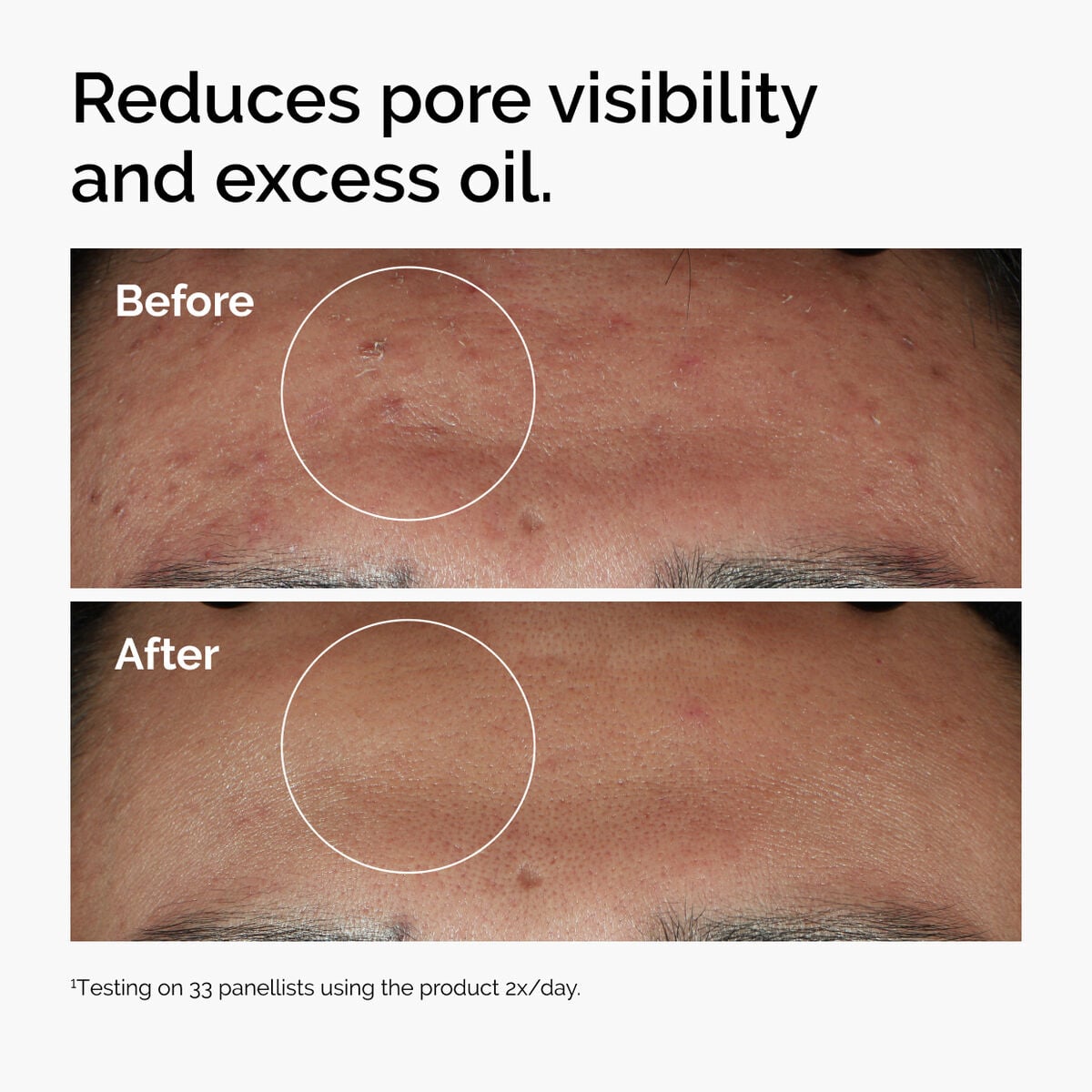 niacinamide-10-zinc-1-t5 ord-niacinamide-zinc-blemish-serum-before-after-pores.jpg