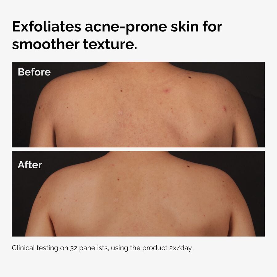 the-body-care-collection-e0 ord-salicylic-acid-body-serum-before-after-graphic-NA.jpg