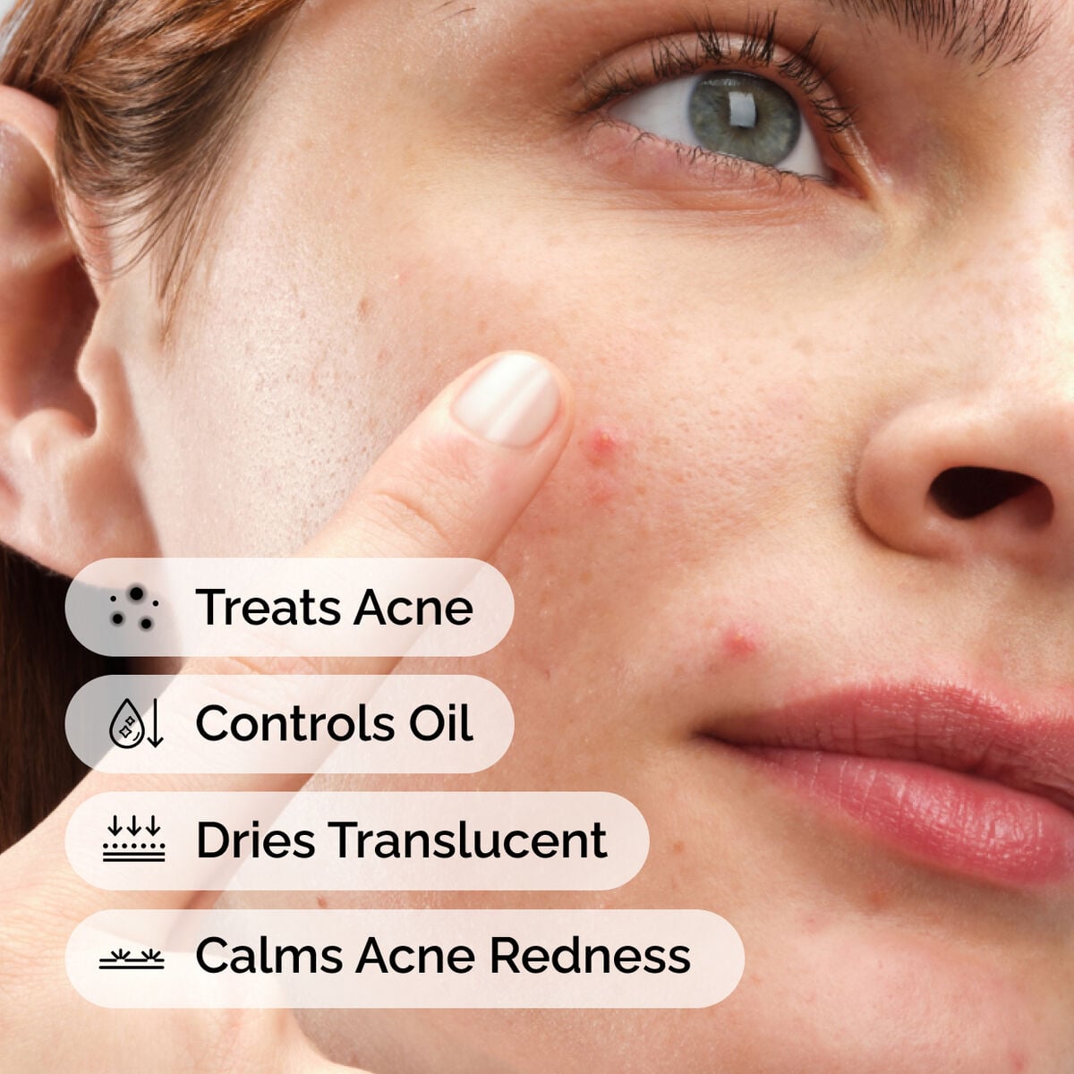 sulfur-10-powder-to-cream-concentrate-n3 ord-sulfur-10pct-powder-to-cream-concentrate-model-application-with-benefits-acne.jpg