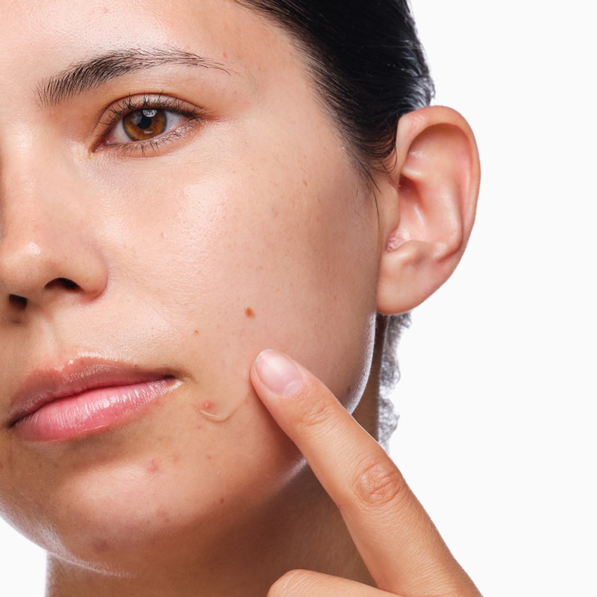 the-acne-set-d7 rdn-the-acne-set-application.png